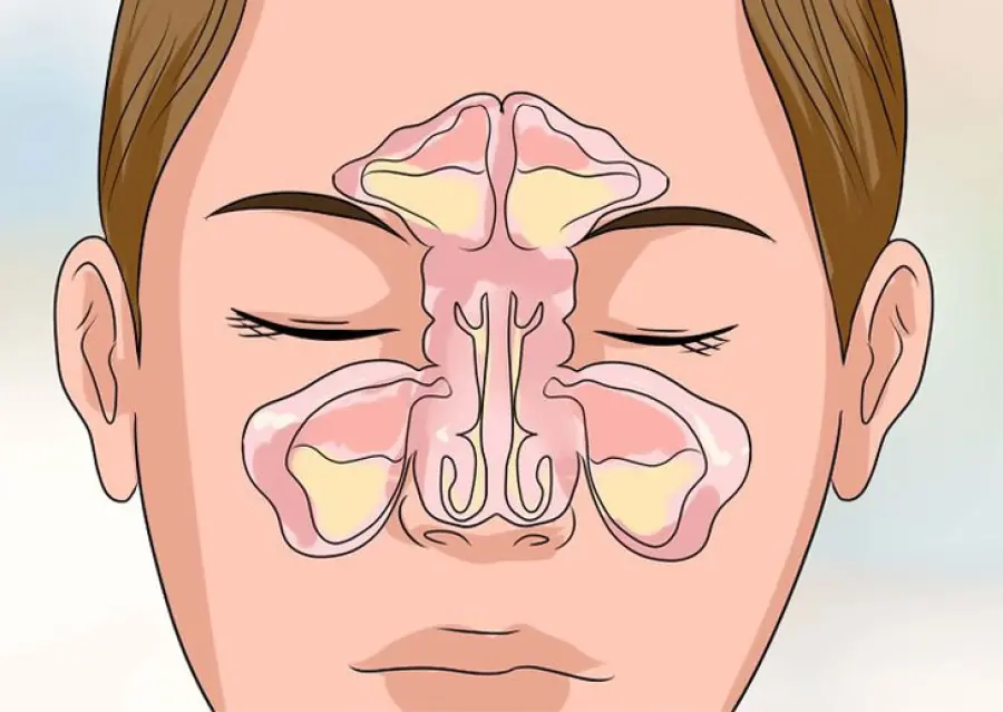 Quali sono i sintomi dei turbinati ipertrofici?