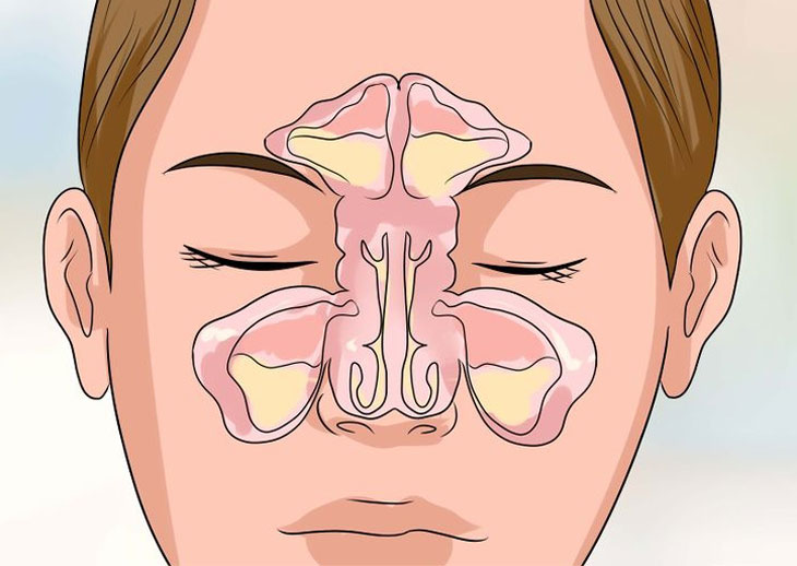 Quali sono i sintomi dei turbinati ipertrofici?